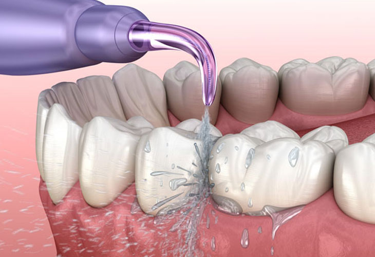 Đầu xịt nên được đặt 90 độ so với hàm răng để làm sạch nhanh chóng hơn
