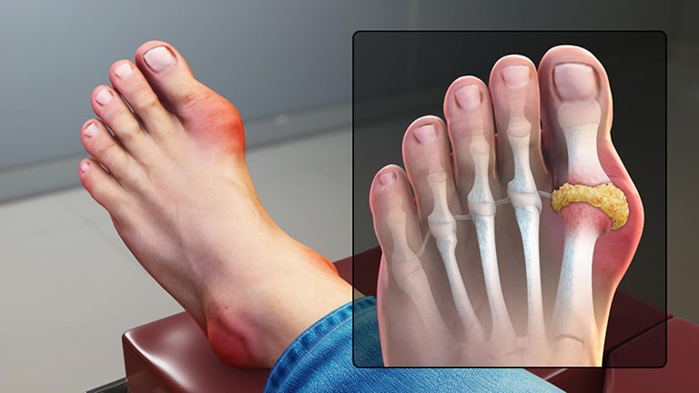 Bệnh viêm khớp nhiễm khuẩn và sưng tấy nặng do bệnh gout không nên đi xe đạp