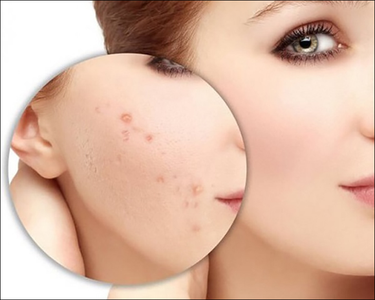Sản phẩm có khả năng làm mờ thâm sẹo nhờ các chiết xuất thiên nhiên