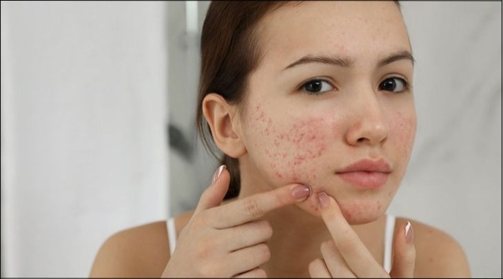 Massage mặt giúp hạn chế mụn trứng cá