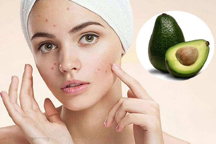 Kem sulfur chứa chiết xuất giúp làm giảm thâm mụn