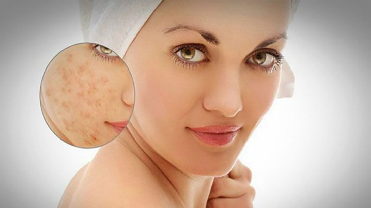 Kem sulfur còn có khả năng làm mờ sẹo do mụn để lại