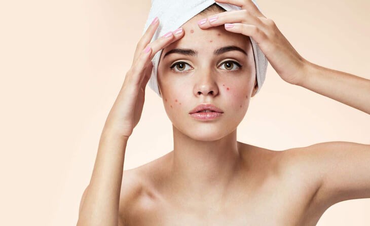 Massage 1 lần/tháng từ 5 - 10 phút/lần giúp bạn cải thiện tình trạng mụn hiệu quả