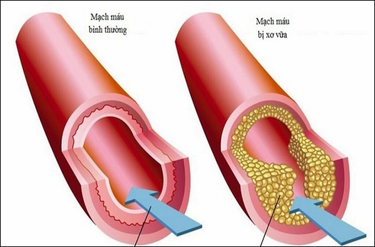 Hệ động mạch ở tay phải bị thu hẹp do xơ vữa, chấn thương sẽ khiến cho huyết áp tay phải cao hơn