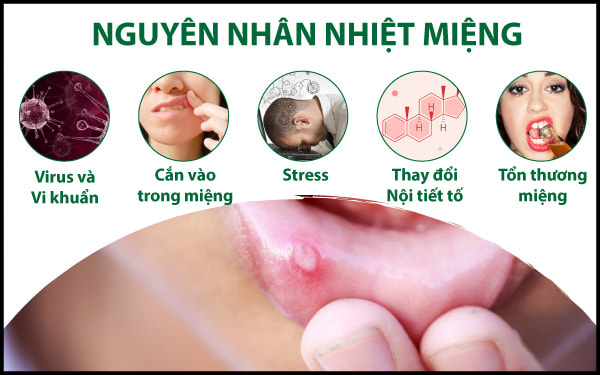 Nguyên nhân gây nhiệt miệng