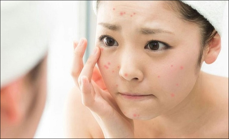 Nước hoa hồng hỗ trợ trị mụn