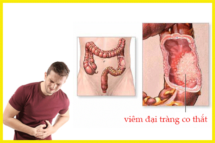 Viêm đại tràng gây khó chịu, chán ăn