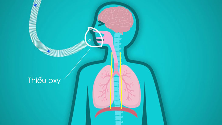 Thiếu oxy do rối loạn hô hấp tế bào