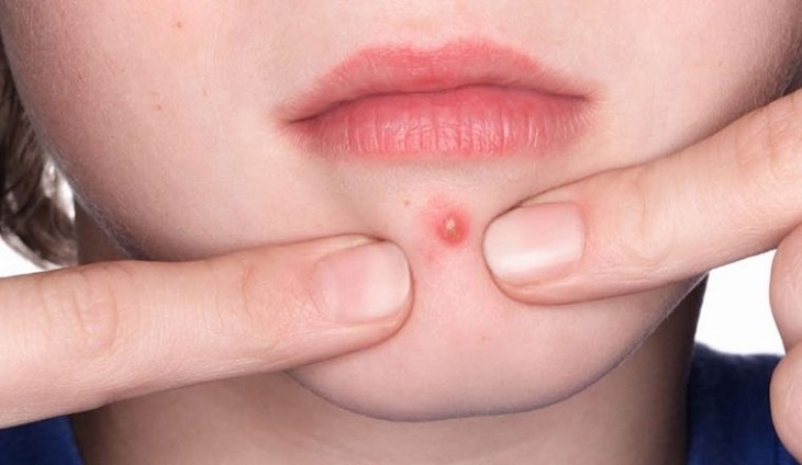 Không được tự ý nặng mụn vì sẽ dễ bị nhiễm khuẩn