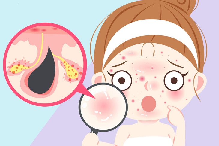 Tuyến dầu bắt đầu hoạt động mạnh dẫn đến tình trạng dễ nổi mụn