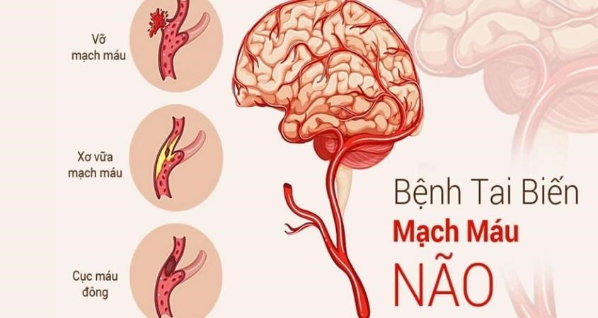 Xe đạp tập thể dục phòng ngừa bệnh tai biến mạch máu não