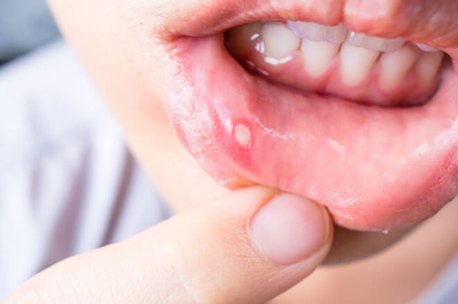 Biểu hiện của nhiệt miệng