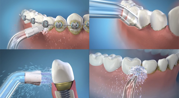 Sử dụng máy tăm nước giúp loại bỏ các mảng bám do thức ăn dính trên răng
