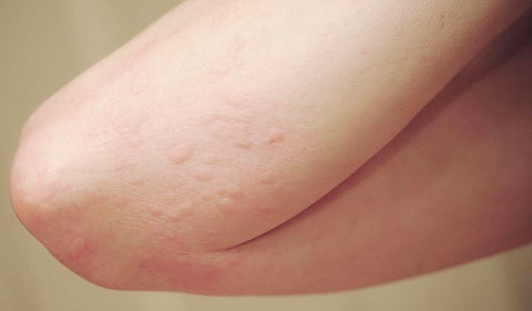 Viêm da, dị ứng với đệm điện